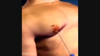 انیمیشین جراحی سینه آقایان (ژنیکوماستی)