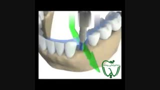 مراحل ایمپلنت دندان