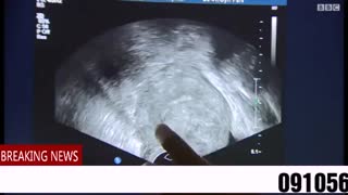 کیست تخمدان