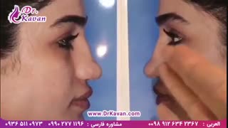 عمل بینی گوشتی