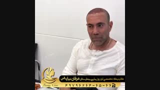 بهترین مرکز کاشت مو در تهران