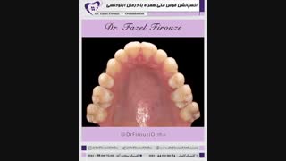 گسترش قوس فکی | دکتر فاضل فیروزی