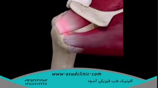چگونگی پارگی تاندون شانه