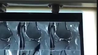 بررسی منیسک در گرافی های تشخیصی MRI
