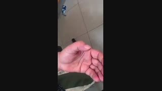 درمان انگشت ماشه ای!!!
