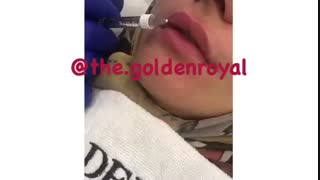 تزریق خط خنده و ژل لب