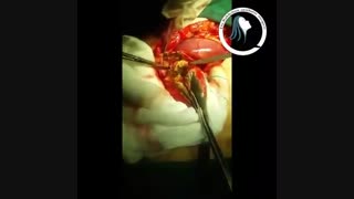 جراحی کیسه صفرا