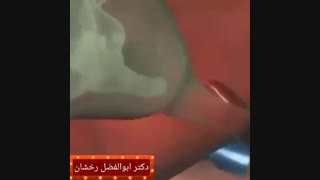 روش های درمان کیسه صفرا