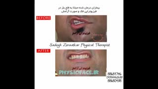 درمان های خانگی فلج عصب صورت