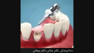 نحوه کشیدن دندان شکسته